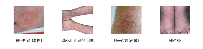 아토피피부염 증상 이미지