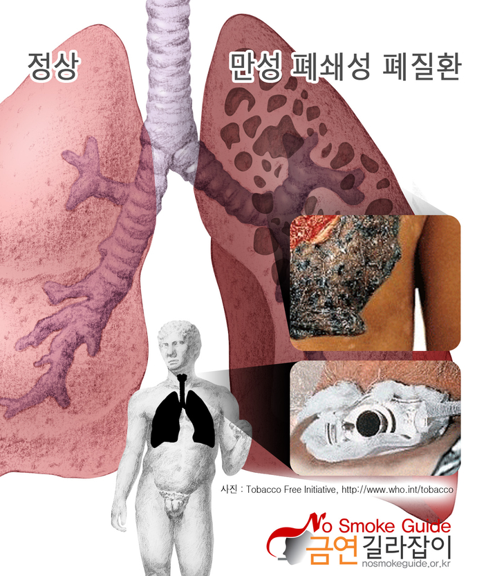 만성폐쇄성폐질환 이미지